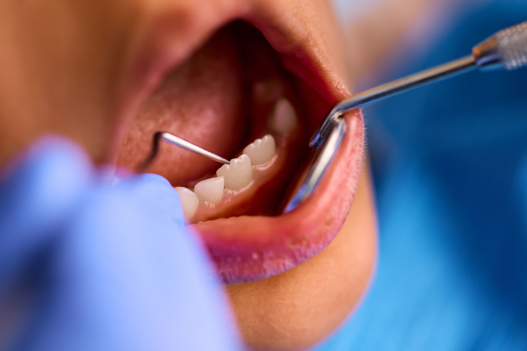 tratar-dientes-leche