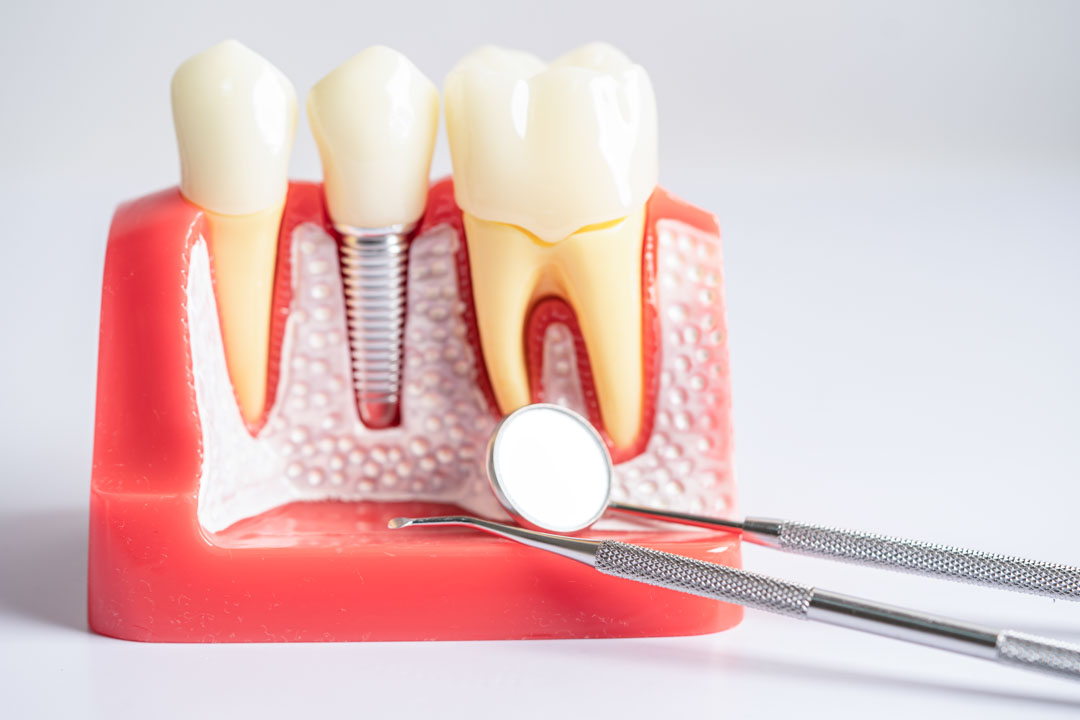 perdida-hueso-implantes