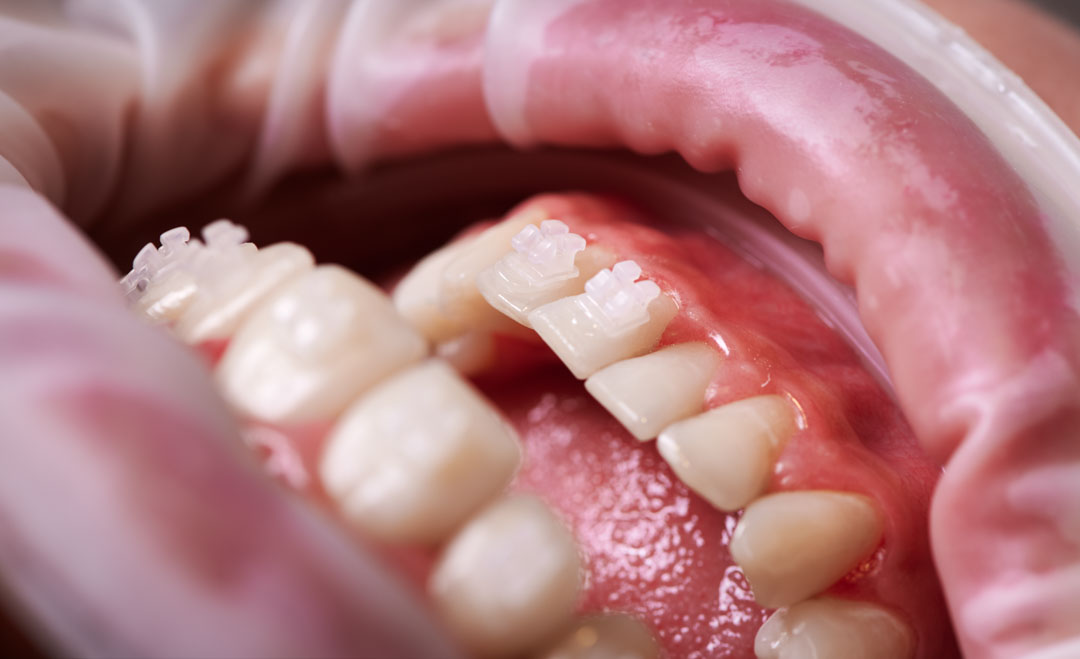 ortodoncia-dientes-poco-hueso