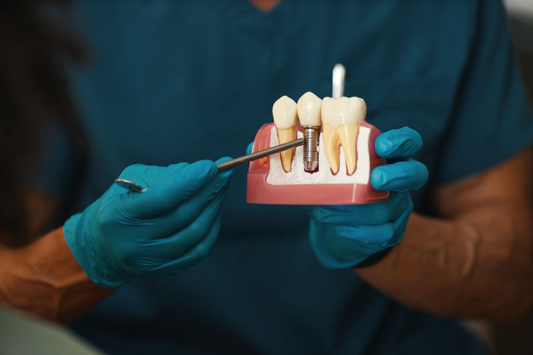 que-es-implante-dental
