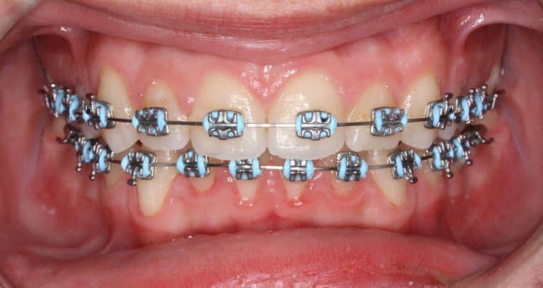 Brackets metálicos
