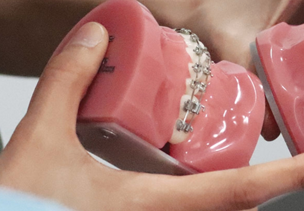 Se me despegó el retenedor de ortodoncia, qué hago? Ortodoncia en Carballo