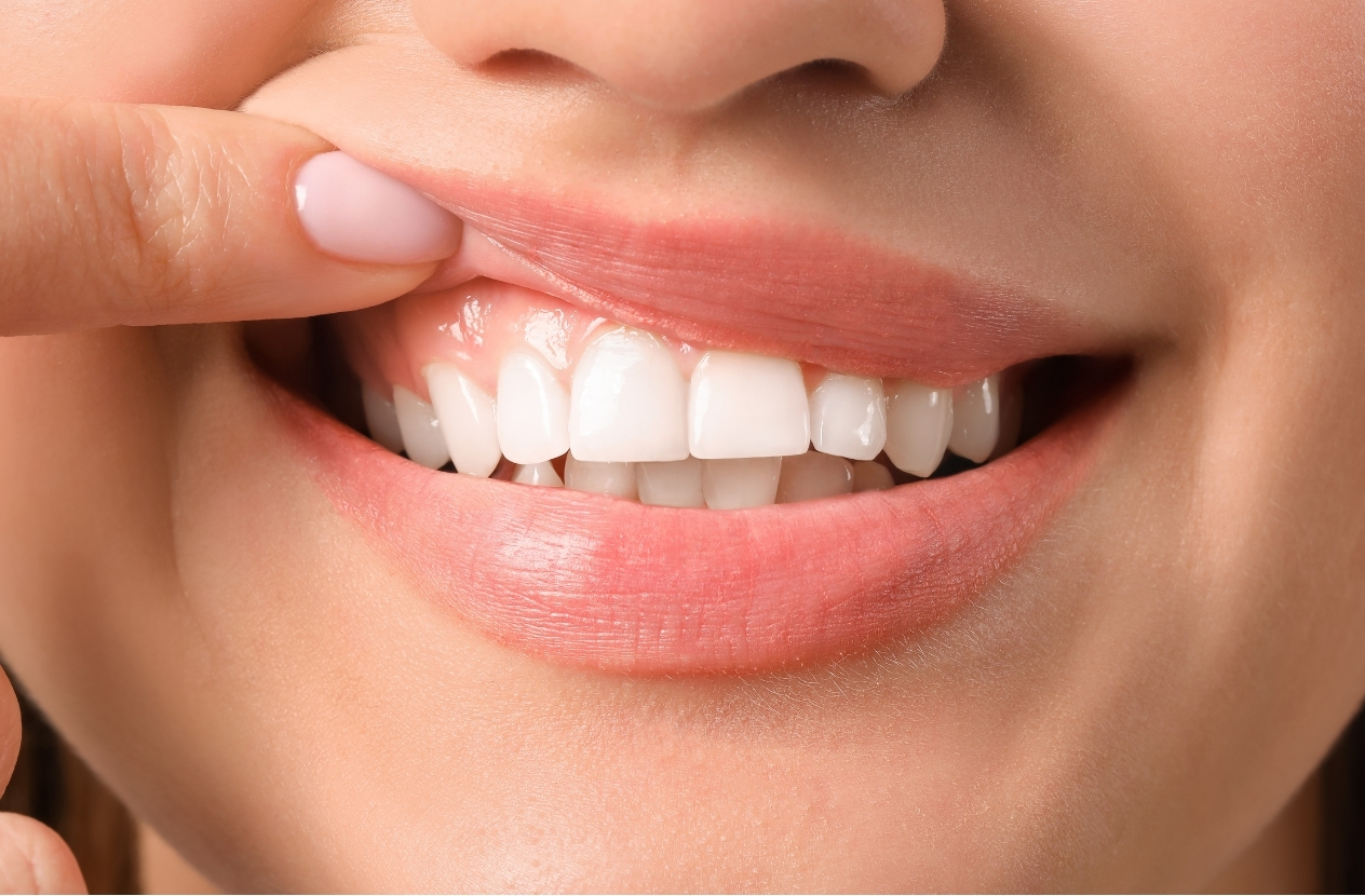 la blancorexia picoblanco clinica dental en carballo