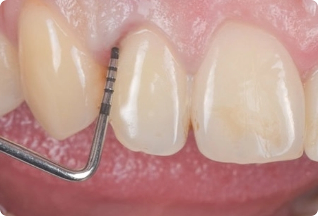 Regeneración periodontal
