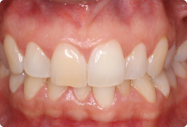 Invisalign + Blanqueamiento