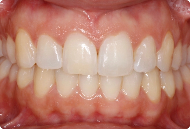 Invisalign + Blanqueamiento