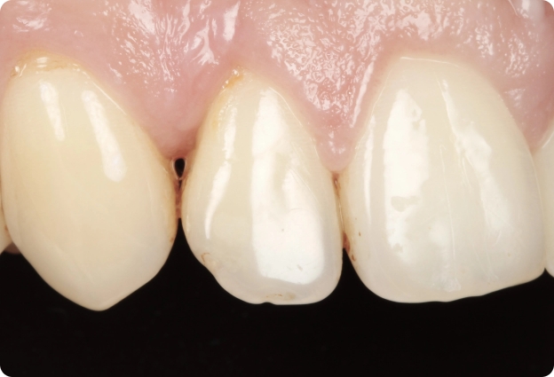 Regeneración periodontal