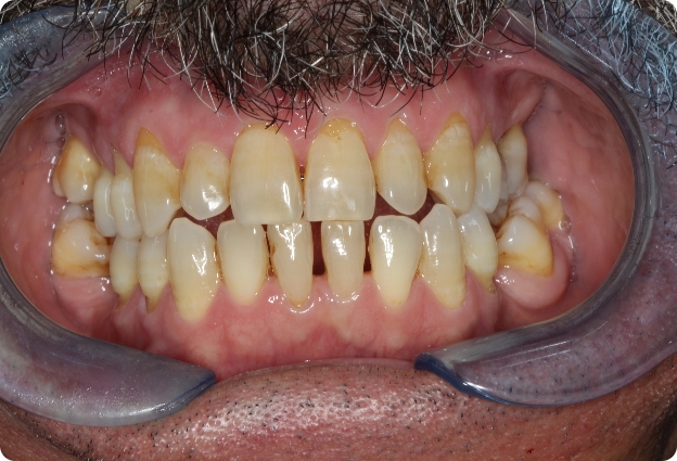 Tratamiento periodontal