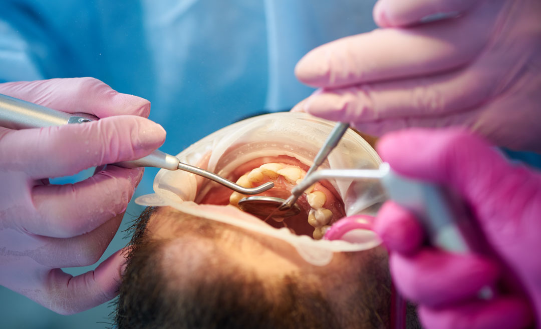 que-es-cirugia-periodontal