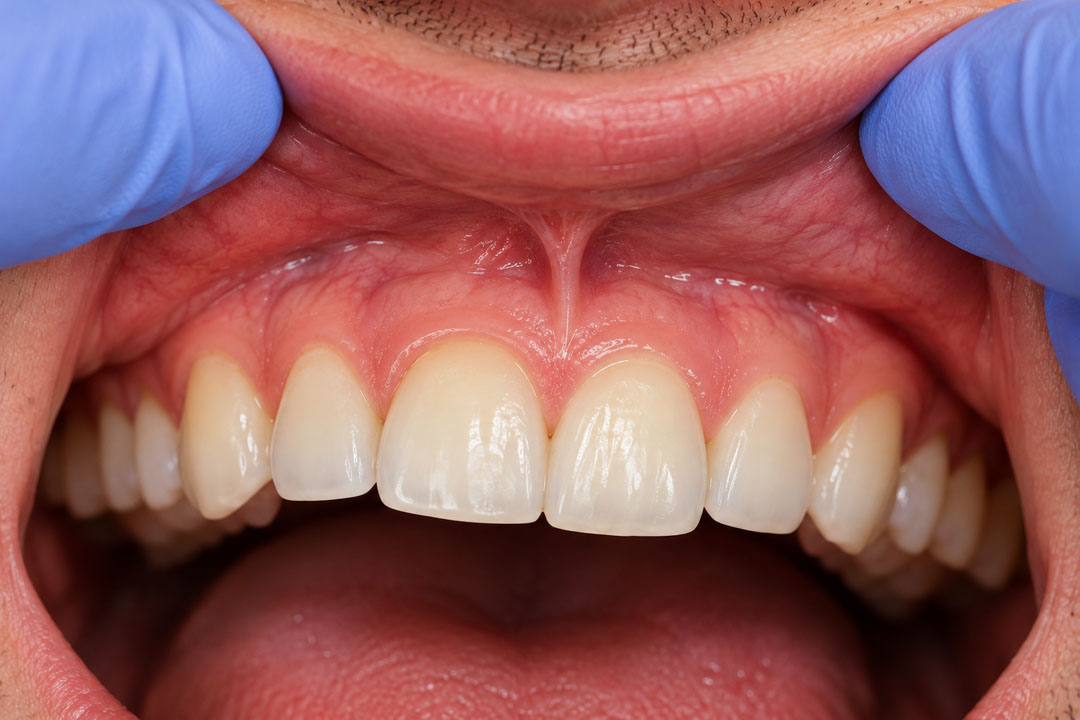 tratar-frenillo-labial-superior