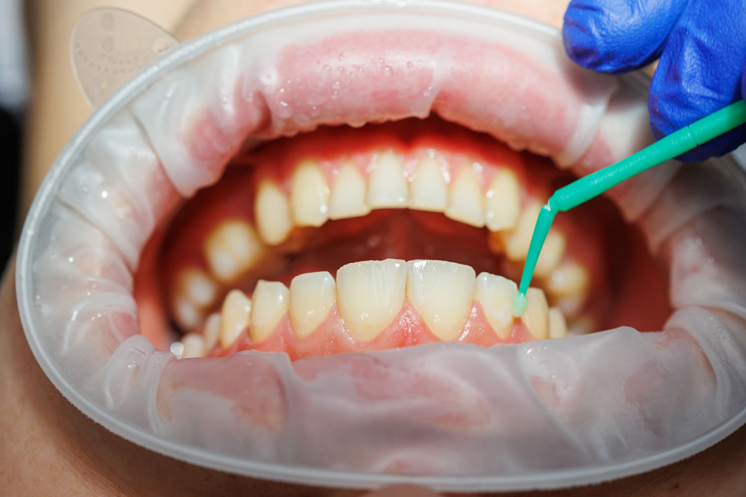 periodontitis-parto-prematuro