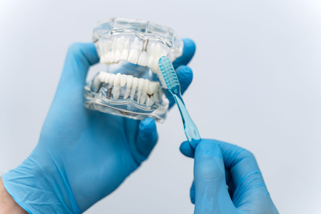 limpiar-implantes-dentales