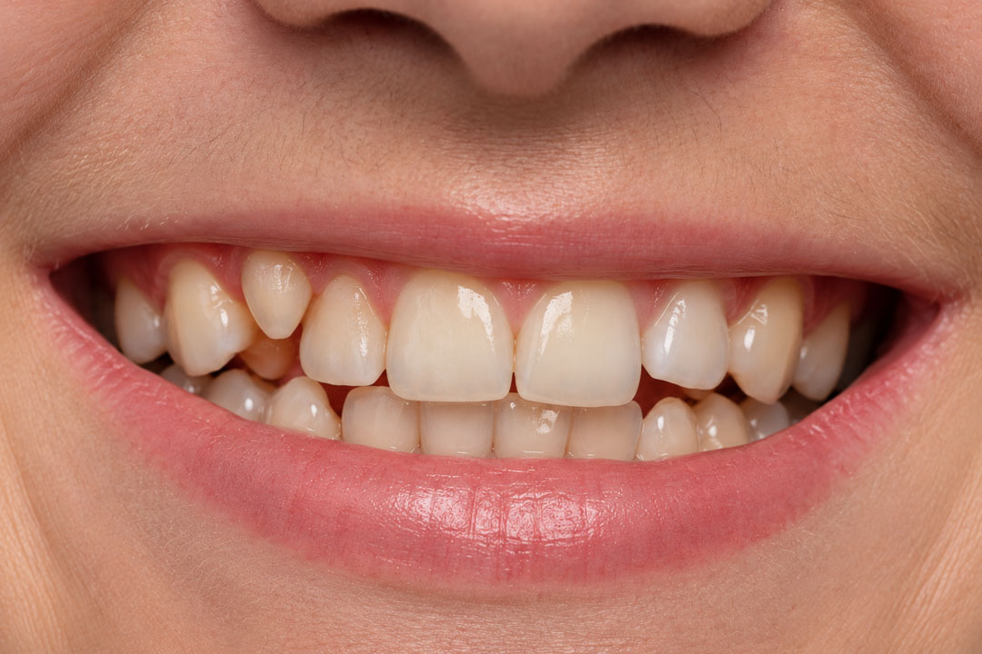 dientes-supernumerarios-que-son
