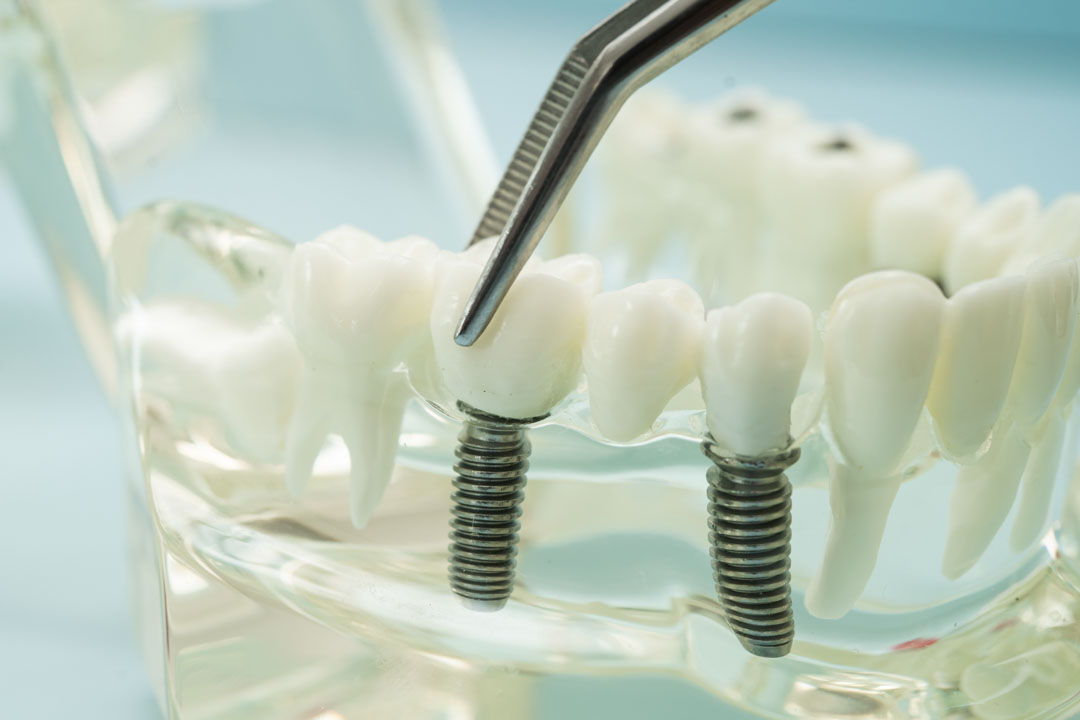 rechazo-implantes-dentales